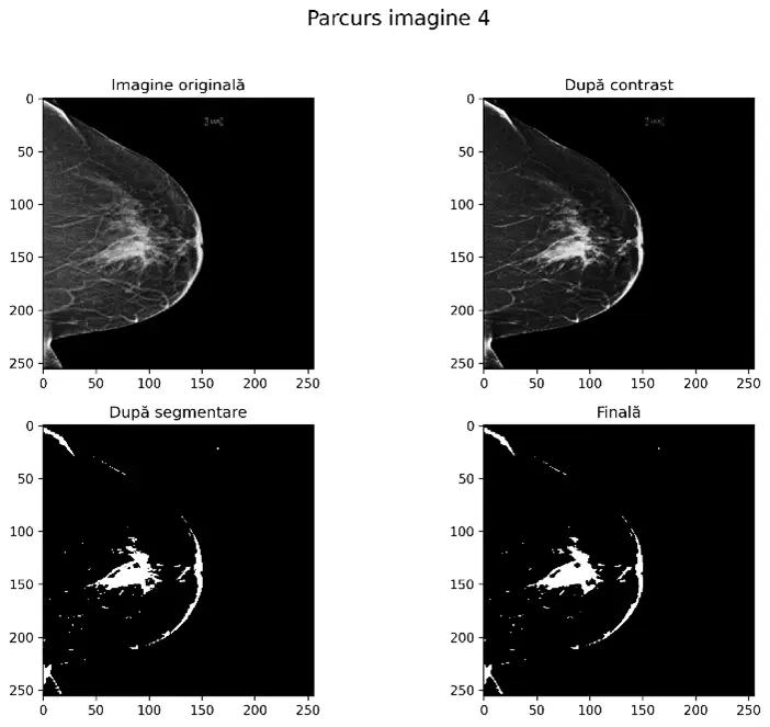 Breast Cancer Detection